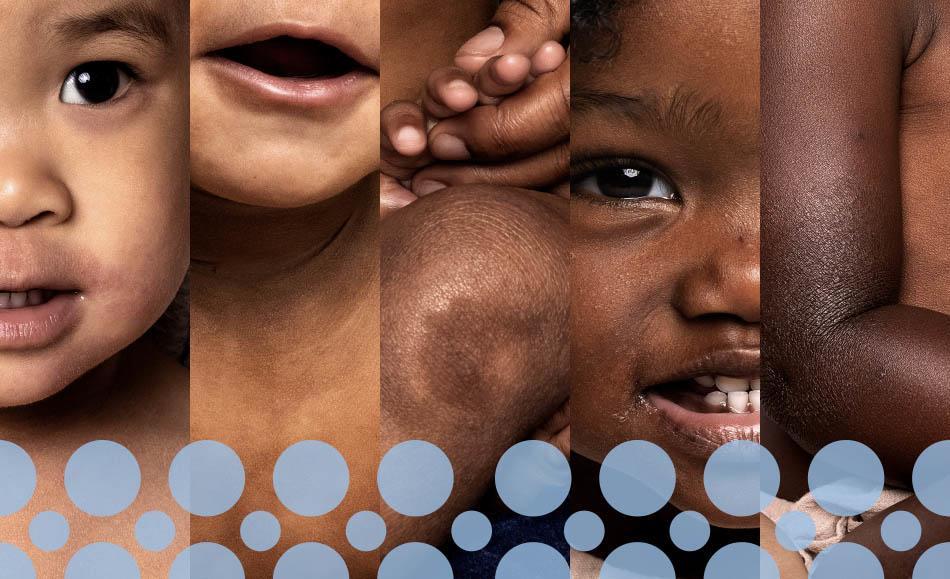Cinq images d’eczéma chez des bébés de couleur