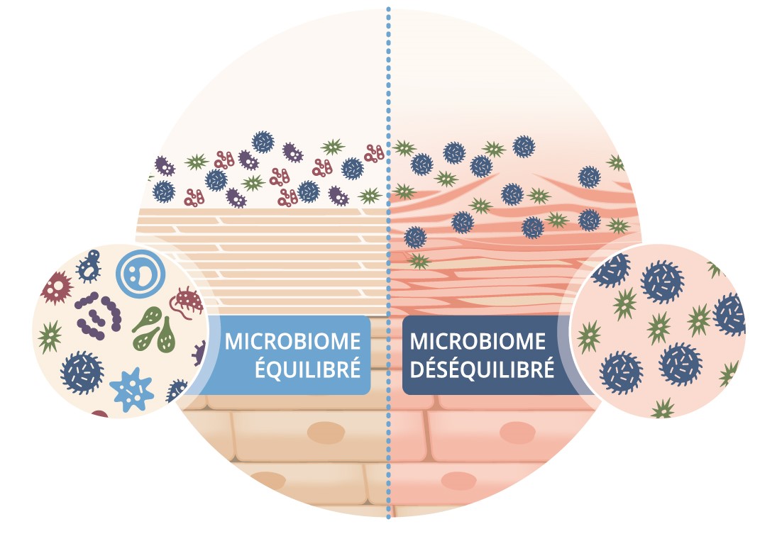 Image illustrant la différence entre un microbiome équilibré et un microbiome déséquilibré