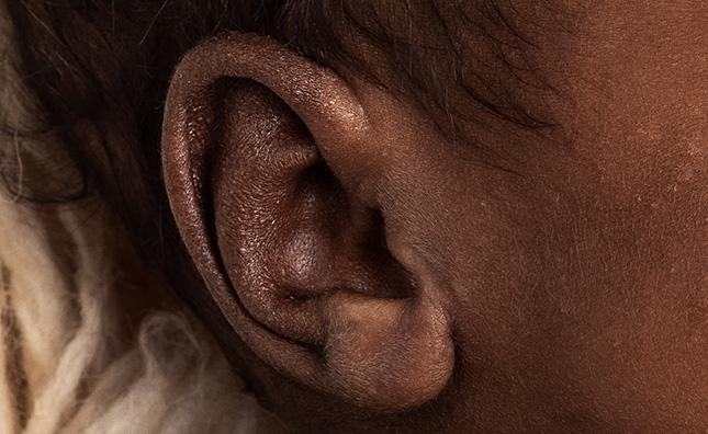 Signes d’eczéma sur les oreilles d’un bébé