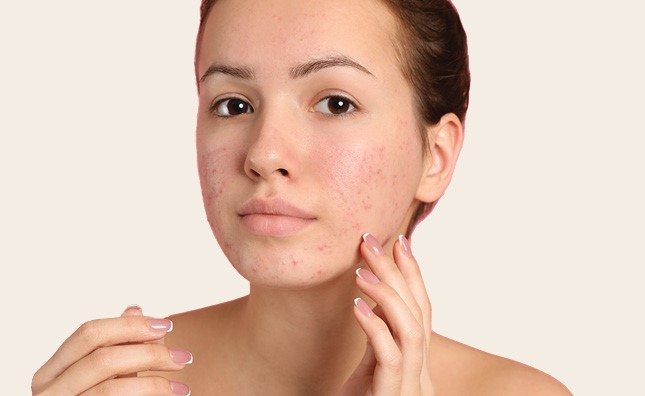 Femme à la peau sujette à l'acné se touchant le visage avec une main.